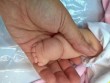 Tay chân bé có ngấn tưởng bụ bẫm, hóa ra bệnh lạ
