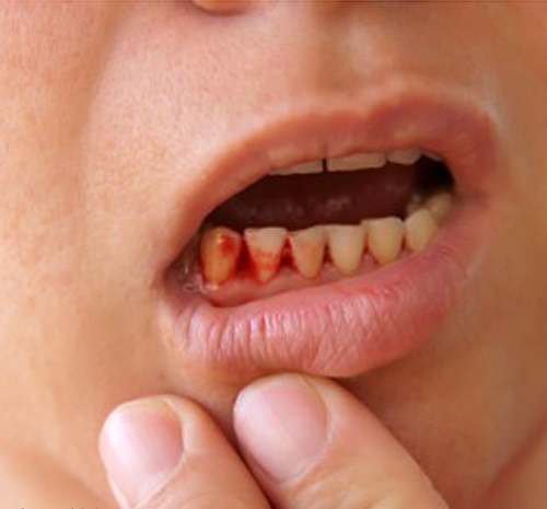 Mệt mỏi, chảy máu chân răng: dấu hiệu của bệnh cực kỳ nguy hiểm - 1