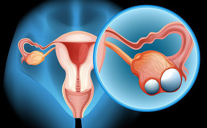 Thuốc tránh thai làm giảm nguy cơ ung thư buồng trứng - 1