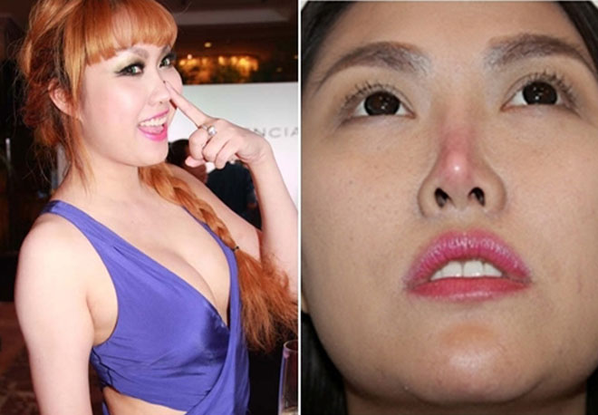 Mũi sưng, hỏng, lệch vì tiêm chất làm đầy "dỏm" - 1