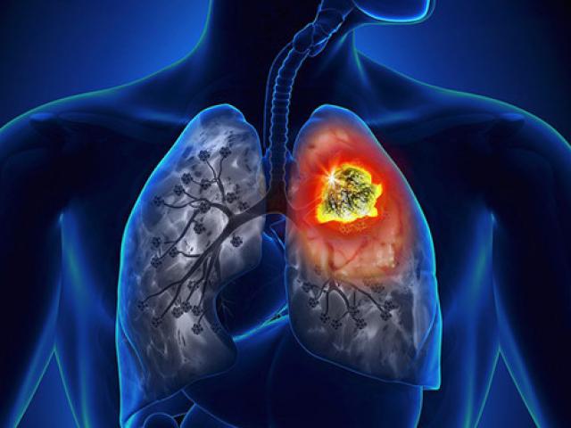 Không muốn tổn thương 2 lá phổi và nguy cơ bị ung thư, nhất định phải biết điều này