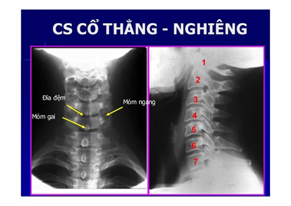 Liệt tay trái do \