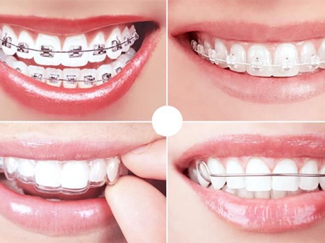 Niềng răng là gì? Niềng răng có đau không và những lưu ý bạn nên biết