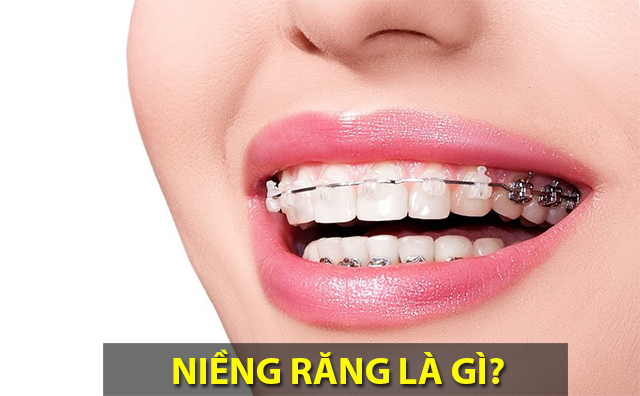 Niềng răng là gì? Niềng răng có đau không và những lưu ý bạn nên biết - 1