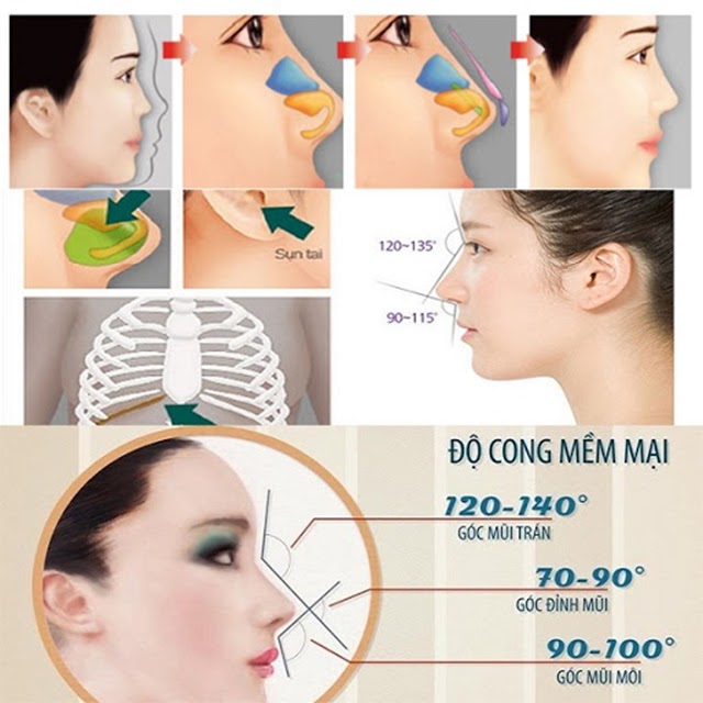 11 phương pháp nâng mũi phổ biến hiện nay - 8