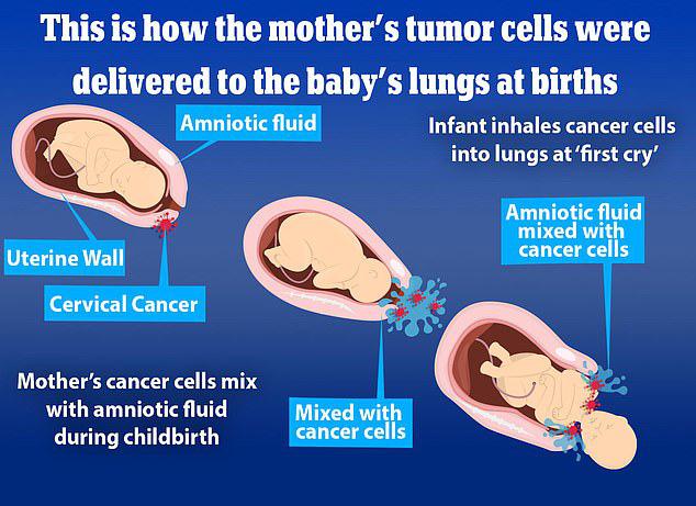 Sốc: 2 trẻ sơ sinh Nhật Bản hít phải tế bào ung thư từ mẹ - 1