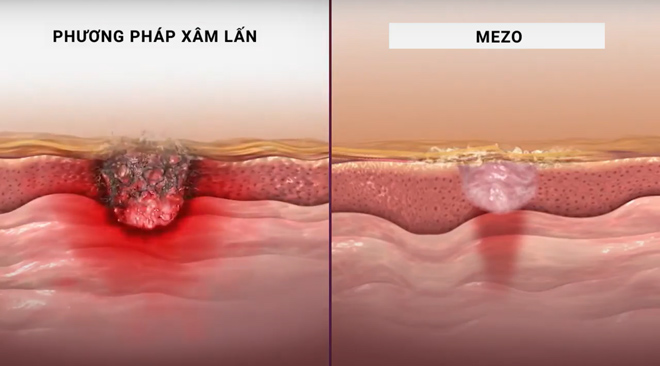 Lắng nghe cách trị sẹo rỗ và trực tiếp trải nghiệm công nghệ triệu đô tại workshop của Dr Huy - 3