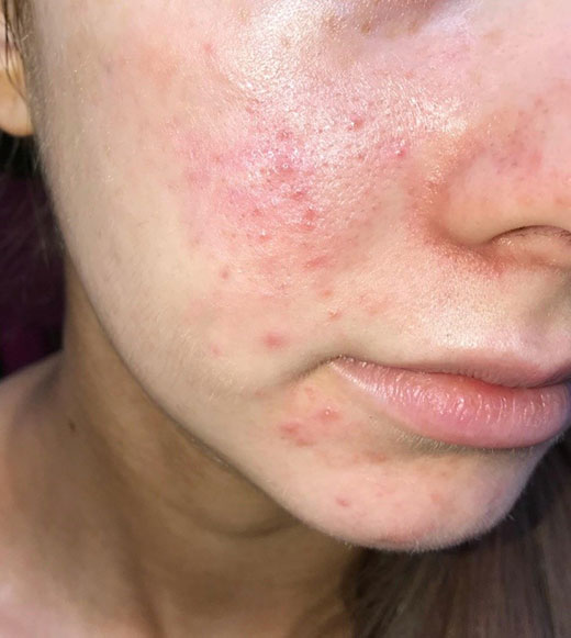 Mụn chi chít, thâm sẹo lổn nhổn: Ai bế tắc vì da mụn cứ mách họ mẹo hiệu quả đến khó tin này! - 1