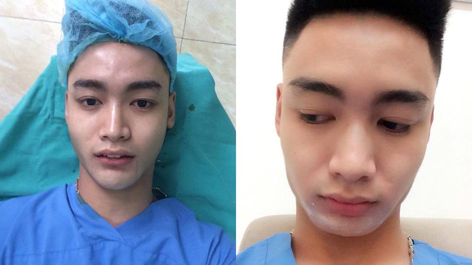 3 chàng trai Việt chi tiền tỷ để "đập mặt đi xây lại", đàn ông cũng “vịt bầu hoá thiên nga” - 9