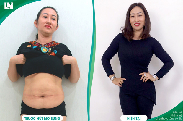 Chuyên gia tạo dáng Bác sĩ Lương Ngọc: Hút mỡ an toàn cần lưu ý gì? - 3