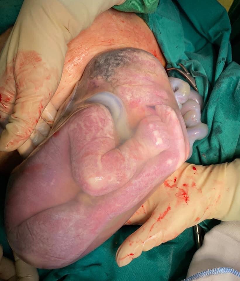 Hiếm gặp: 2 bé song sinh chào đời, 1 bé còn nguyên trong bọc ối - 1