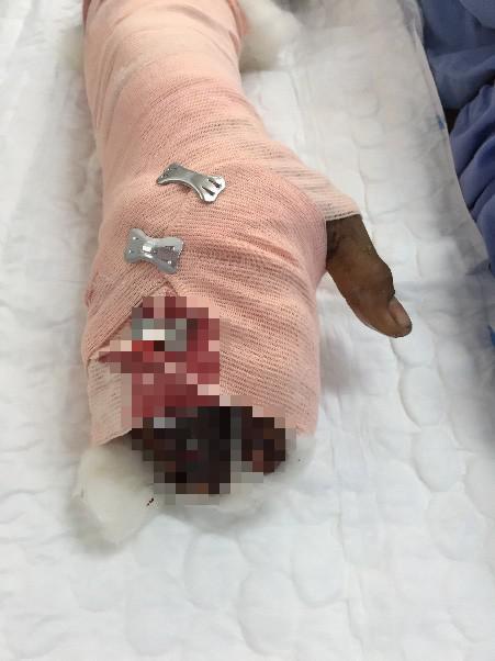 Đi cắt lá sả trên núi, 2 người bị rắn chàm quạp cắn nguy kịch - 2