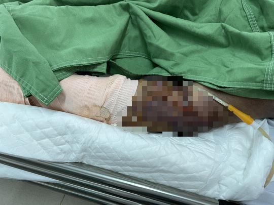 Đi cắt lá sả trên núi, 2 người bị rắn chàm quạp cắn nguy kịch - 4