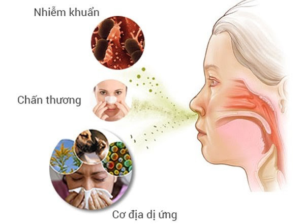 Tìm hiểu về viêm mũi và giải pháp hiệu quả từ thảo dược - 1