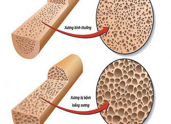 Dấu hiệu thiếu canxi ở người lớn dễ nhận biết nhất, nếu xuất hiện 1 trong 6 triệu chứng này nên khám sớm - 1