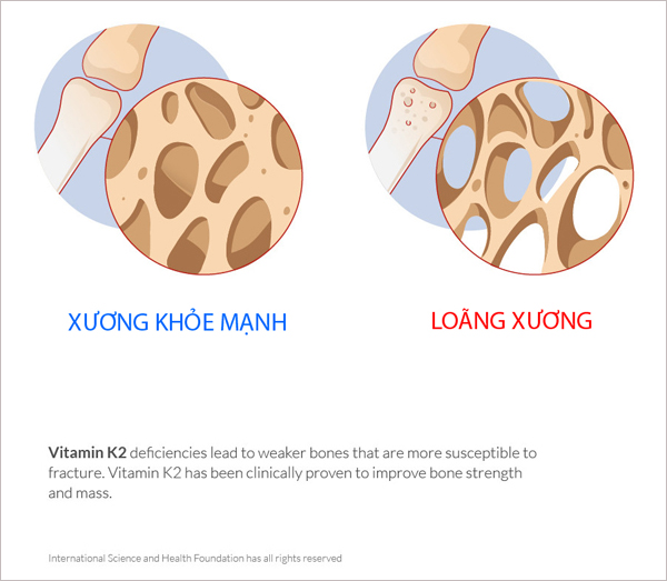 Không chỉ giúp trẻ tăng chiều cao tối ưu, đây là 3 lợi ích hiếm có khiến bạn phải bổ sung vitamin K2 ngay cho con! - 2