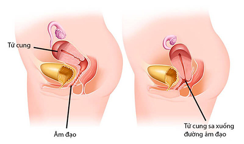 3 cách phục hồi sa tử cung tại nhà an toàn từ nhẹ tới nặng - 1