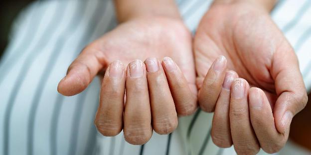 Không nên bỏ qua những dấu hiệu này trên móng tay - 3