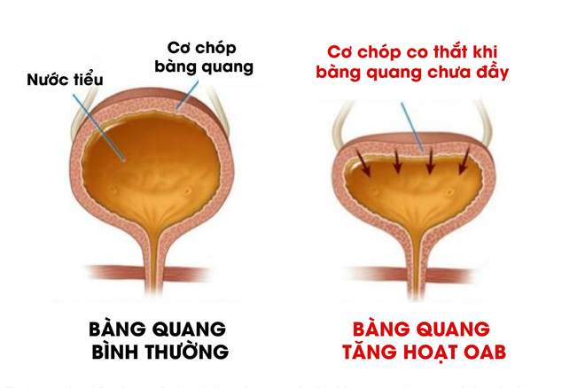 Cảnh báo: Tiểu đêm 3-4 lần - Dấu hiệu bàng quang đang “kêu cứu”, cẩn thận hối không kịp! - 2