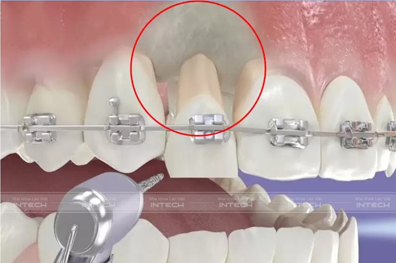 Niềng răng mắc cài nhân đôi hiệu quả với công nghệ X-Matrix - 1