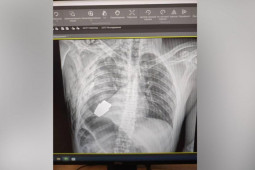 Chụp X quang, phát hiện thứ ”rợn người” trong cơ thể binh sĩ Ukraine