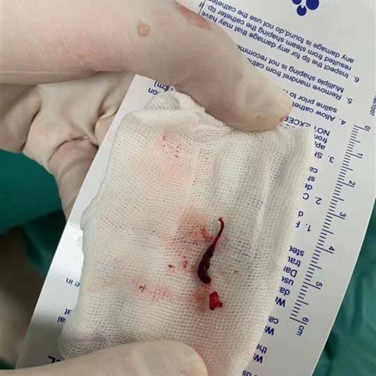 Nôn liên tục 4 tiếng vì tưởng đau dạ dày, người đàn ông mắc căn bệnh có tỷ lệ tử vong cao nhất - 1