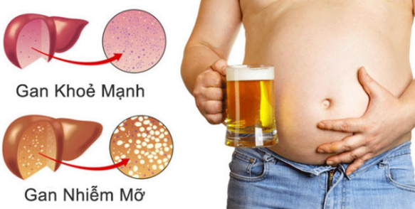 Những thực phẩm ăn khi uống rượu bia sẽ làm tăng nguy cơ ung thư gan, cần sớm thay đổi thói quen xấu này! - 1