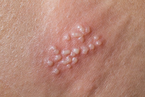 Nam sinh 19 tuổi bị chảy mủ “vùng kín” vì mắc bệnh lậu, không nhớ đã có bao nhiêu bạn tình - 1