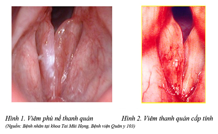 Biến chứng của viêm thanh quản có thể đe dọa tính mạng, khi nào ...