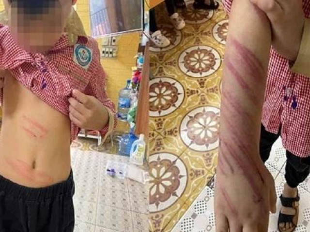 Bố dượng bạo hành con riêng của vợ khai “bức xúc vì cháu nó hay trộm tiền”