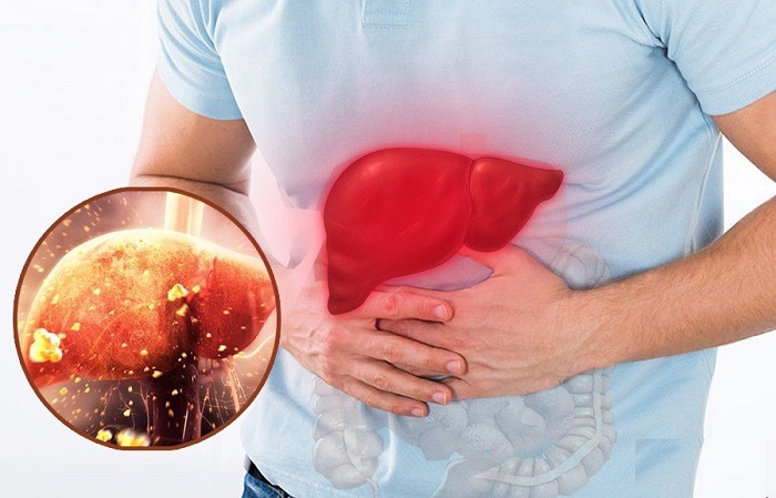 Điểm mặt những thực phẩm tồi tệ nhất cho sức khỏe lá gan - 1