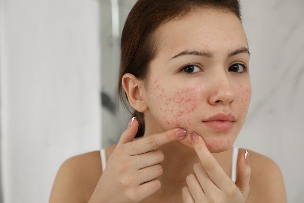 Các cách giúp giảm thâm và mẩn đỏ cực nhanh khi bị mụn - 1