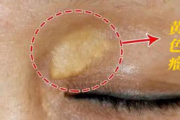 8 dấu hiệu bệnh tim trên khuôn mặt, người tinh ý dễ dàng nhận ra