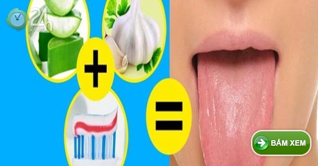 10 cách chữa bệnh lưỡi trắng đơn giản nhất ngay tại nhà