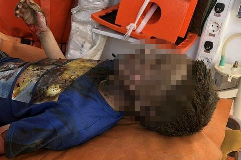 Chạm phải dòng điện 10.000 vôn, trở thành... "cậu bé may mắn nhất tháng" - 1