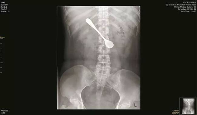 Bệnh nhân liều mạng chữa hóc xương, bác sĩ hốt hoảng thấy thứ này trong bụng - 1
