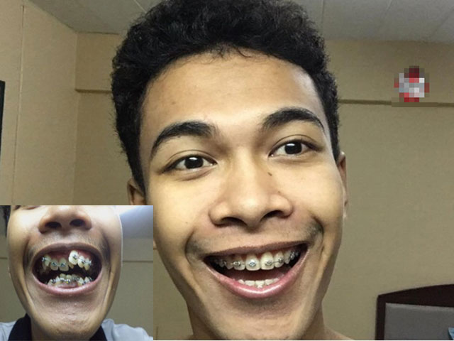 Choáng với ca "xây lại" hàm răng "9-6-3-0" của chàng thanh niên Thái Lan