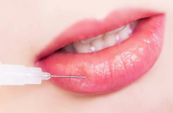 Tiêm tan filler, cựu người mẫu suýt chết, môi sưng vêu như ong đốt - 1