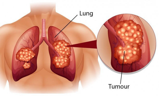 6 biện pháp phòng ung thư phổi - 1