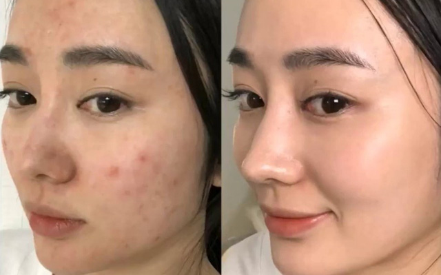 Hè đến dễ mụn đầy mặt, tham khảo ngay phương pháp 30 phút để da sạch thoáng - 2