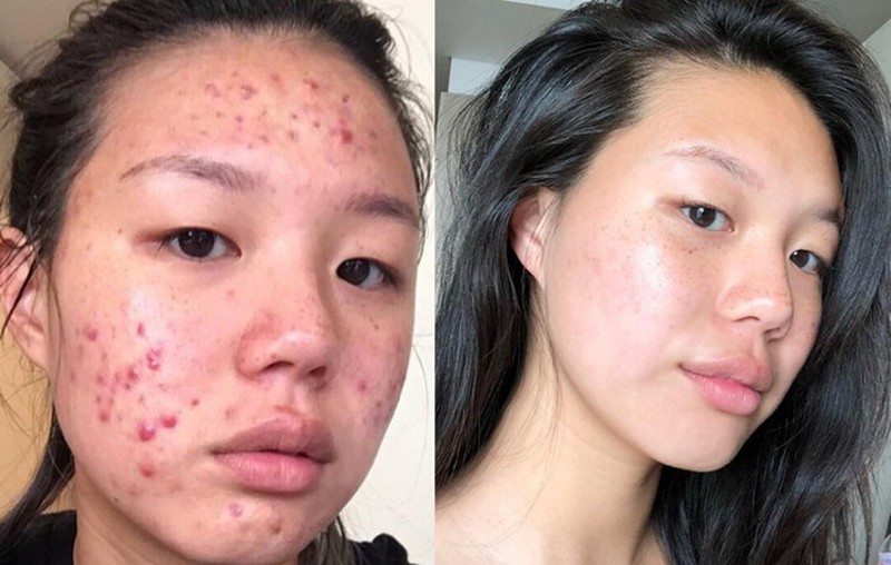 Hè đến dễ mụn đầy mặt, tham khảo ngay phương pháp 30 phút để da sạch thoáng - 4