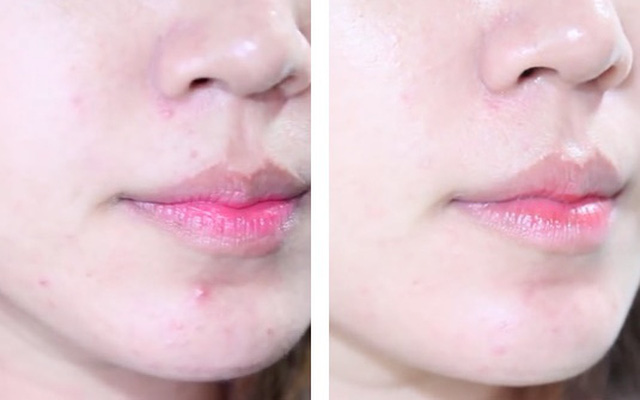 Hè đến dễ mụn đầy mặt, tham khảo ngay phương pháp 30 phút để da sạch thoáng - 3