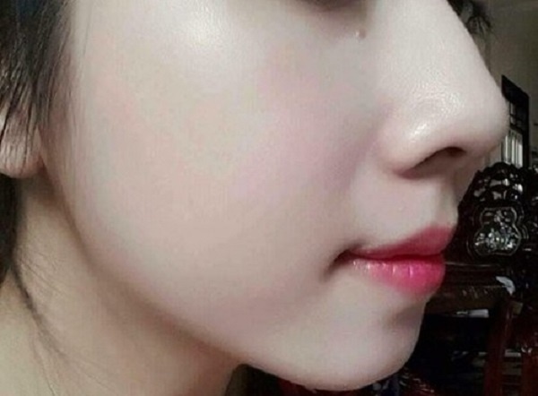 Hè đến dễ mụn đầy mặt, tham khảo ngay phương pháp 30 phút để da sạch thoáng - 5