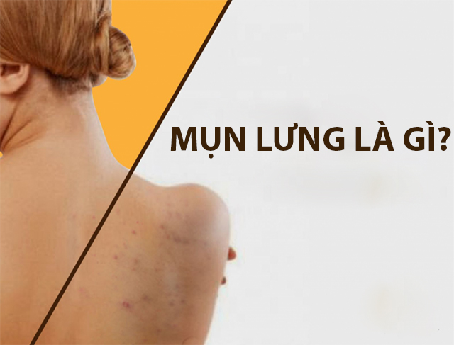 Làm sao để chuẩn bị và sử dụng khổ qua để trị mụn lưng?
