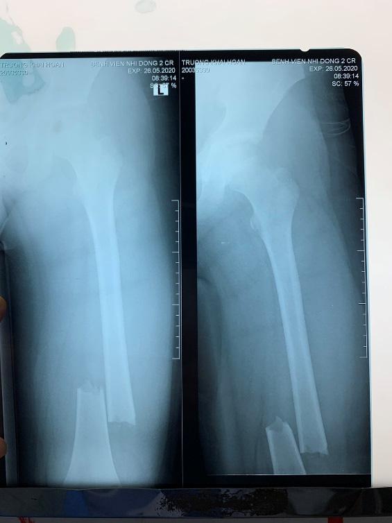 Bác sĩ thở phào khi 2 học sinh bị cây phượng bật gốc đè đã tỉnh sau phẫu thuật - 2