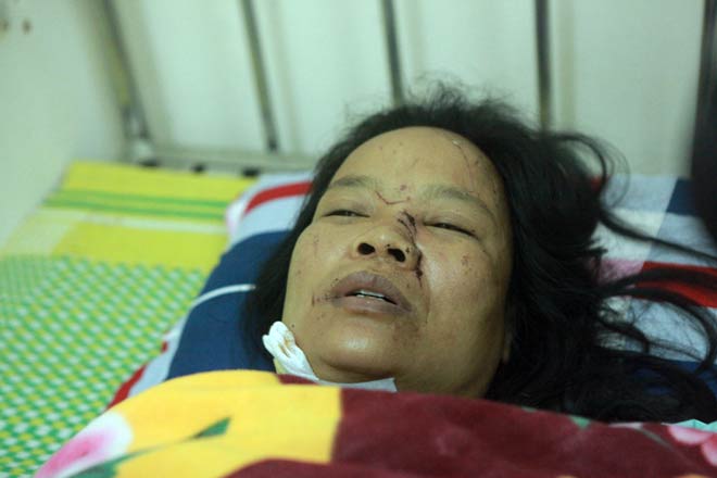 Nạn nhân vụ lốc xoáy ở Vĩnh Phúc: “Tôi ôm cánh tay lủng lẳng, đầy máu chạy trong mưa” - 3