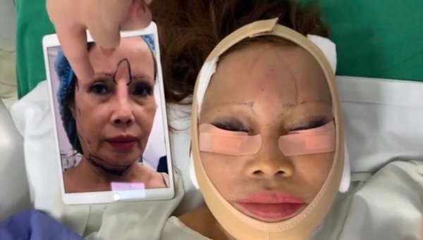 “Cô dâu 62 lấy chồng 26" gặp biến chứng vì ham phẫu thuật "trẻ hóa" quá đà? - 3