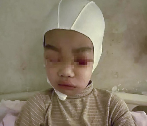 Nói chuyện trong lớp, nam sinh Trung Quốc bị thầy giáo giật tóc tới chấn thương sọ não - 1
