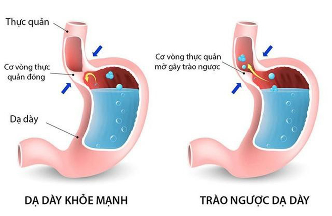 Chắc chắn bạn chưa hiểu hết về trào ngược dạ dày - Chuyên gia tư vấn cách thoát bệnh dễ dàng - 2