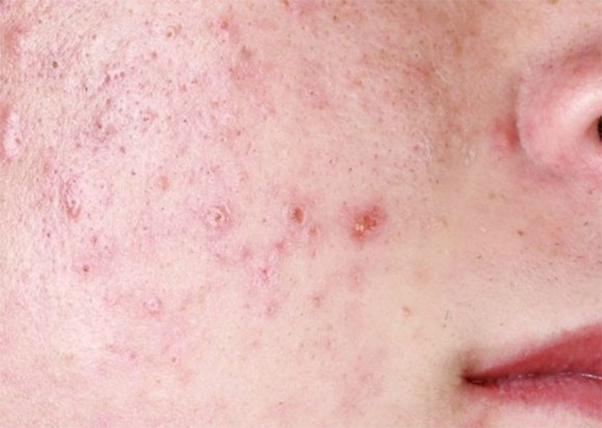 Ai mụn nhỏ, mụn to, mụn li ti, sẹo thâm: Cứ tuân thủ đúng 1 bước này, sẽ hết mụn, sạch thâm! - 1